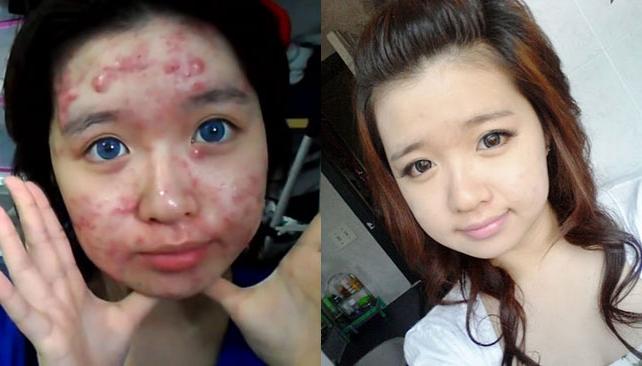 maquillaje antes y despues acne